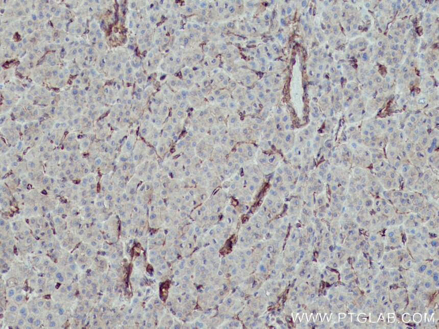 Immunohistochemistry (IHC) staining of human liver cancer tissue using MYL9 Polyclonal antibody (15354-1-AP)