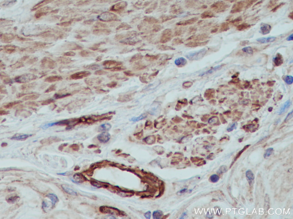 Immunohistochemistry (IHC) staining of human colon cancer tissue using MYL9 Polyclonal antibody (15354-1-AP)