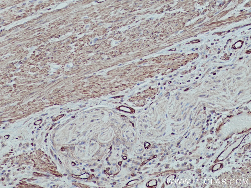 IHC staining of human colon cancer using 15354-1-AP