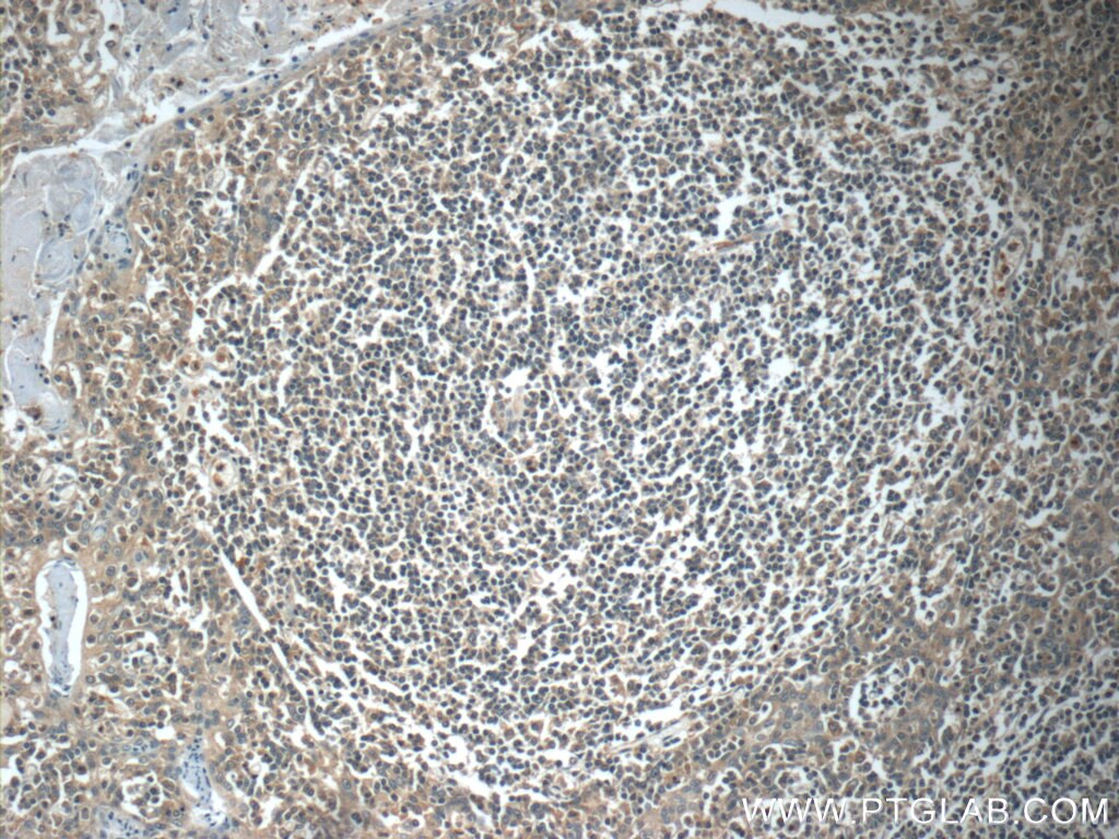 Immunohistochemistry (IHC) staining of human tonsillitis tissue using MYLK4 Polyclonal antibody (24309-1-AP)