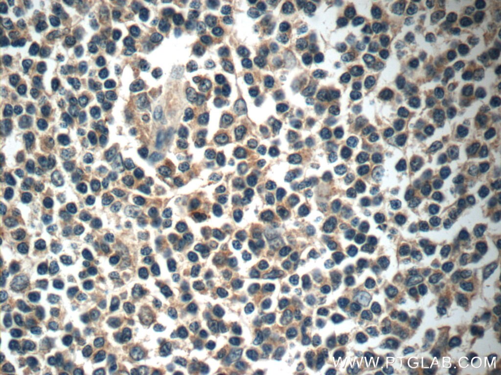 Immunohistochemistry (IHC) staining of human tonsillitis tissue using MYLK4 Polyclonal antibody (24309-1-AP)