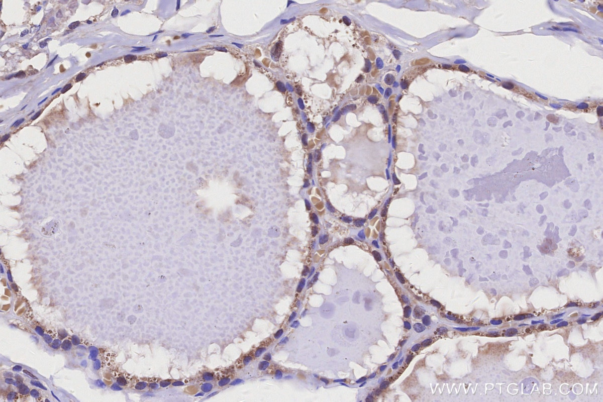 Immunohistochemistry (IHC) staining of human thyroid cancer tissue using MYO1D Polyclonal antibody (14028-1-AP)