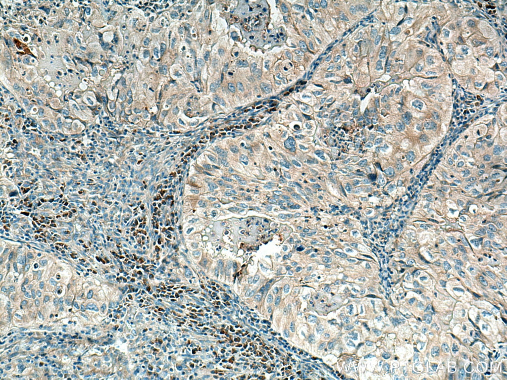 Immunohistochemistry (IHC) staining of human lung cancer tissue using MYO1E Polyclonal antibody (17768-1-AP)