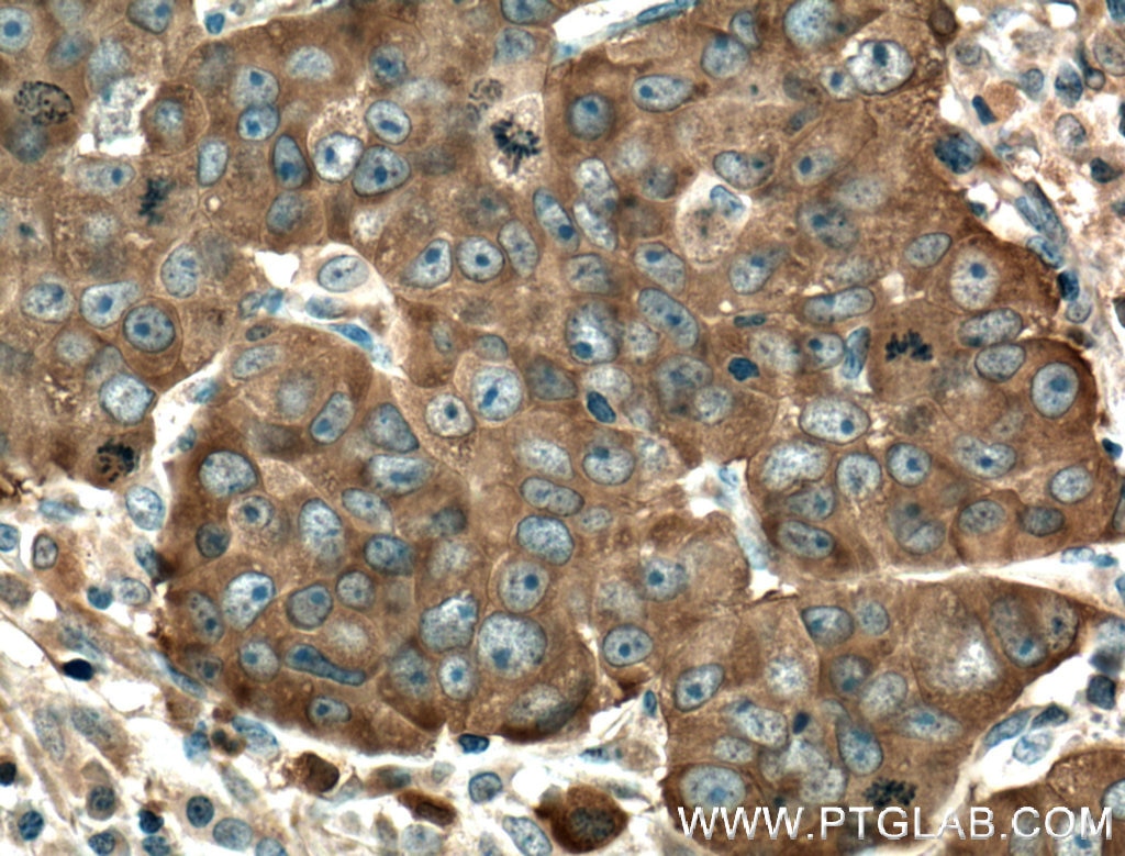 Immunohistochemistry (IHC) staining of human prostate cancer tissue using MYO6 Polyclonal antibody (26778-1-AP)