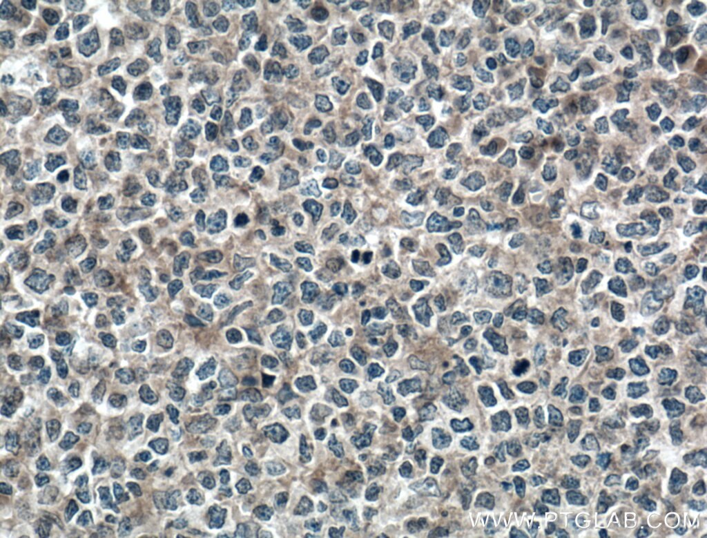 Immunohistochemistry (IHC) staining of human tonsillitis tissue using MYO9B Polyclonal antibody (12432-1-AP)