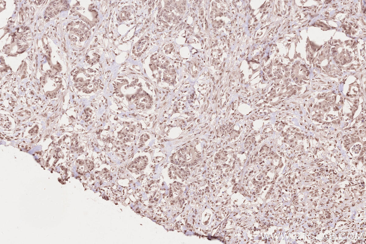 IHC staining of human rectal cancer using 16180-1-AP Immunohistochemistry (IHC) staining of human rectal cancer tissue using MYPN-Specific Polyclonal antibody (16180-1-AP)