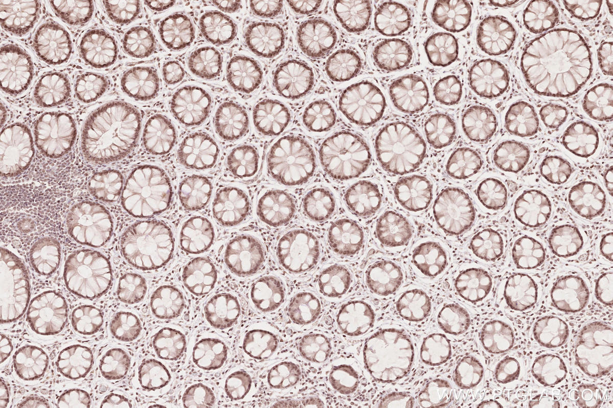 IHC staining of human rectal cancer using 16180-1-AP Immunohistochemistry (IHC) staining of human rectal cancer tissue using MYPN-Specific Polyclonal antibody (16180-1-AP)