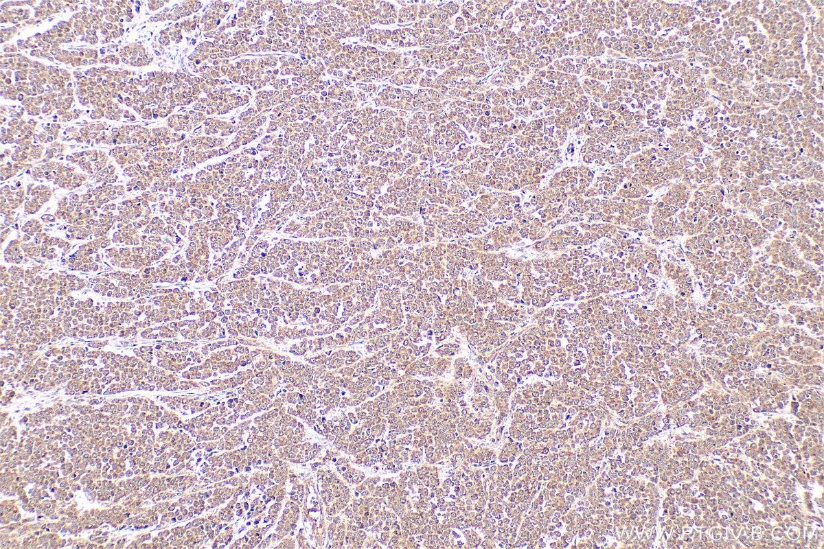 Immunohistochemistry (IHC) staining of human colon cancer tissue using MYPT1 Polyclonal antibody (22117-1-AP)