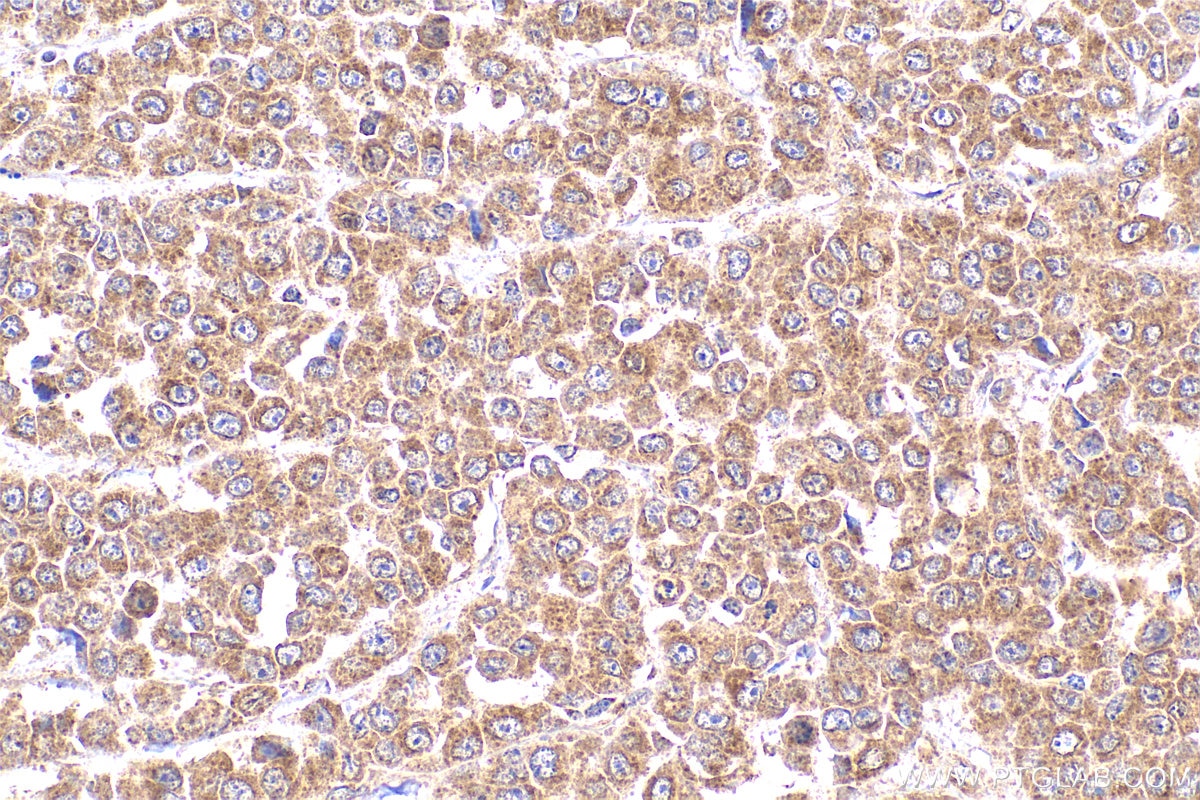 Immunohistochemistry (IHC) staining of human colon cancer tissue using MYPT1 Polyclonal antibody (22117-1-AP)