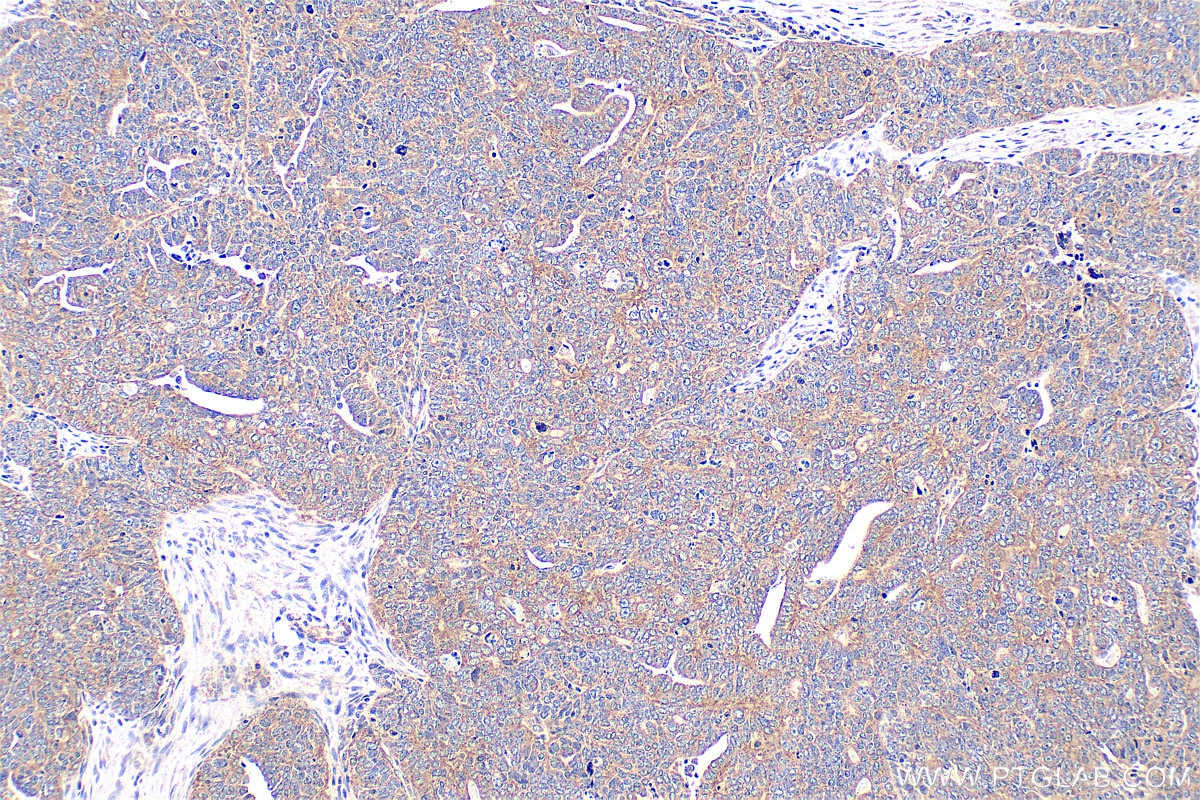 Immunohistochemistry (IHC) staining of human ovary tumor tissue using MYPT1 Polyclonal antibody (22117-1-AP)