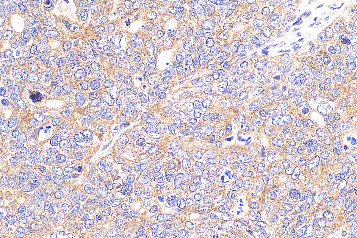 Immunohistochemistry (IHC) staining of human ovary tumor tissue using MYPT1 Polyclonal antibody (22117-1-AP)