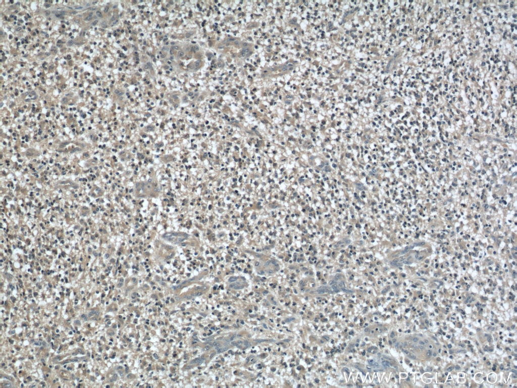 Immunohistochemistry (IHC) staining of human gliomas tissue using MYPT1 Polyclonal antibody (22117-1-AP)