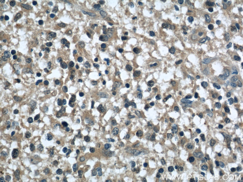 Immunohistochemistry (IHC) staining of human gliomas tissue using MYPT1 Polyclonal antibody (22117-1-AP)
