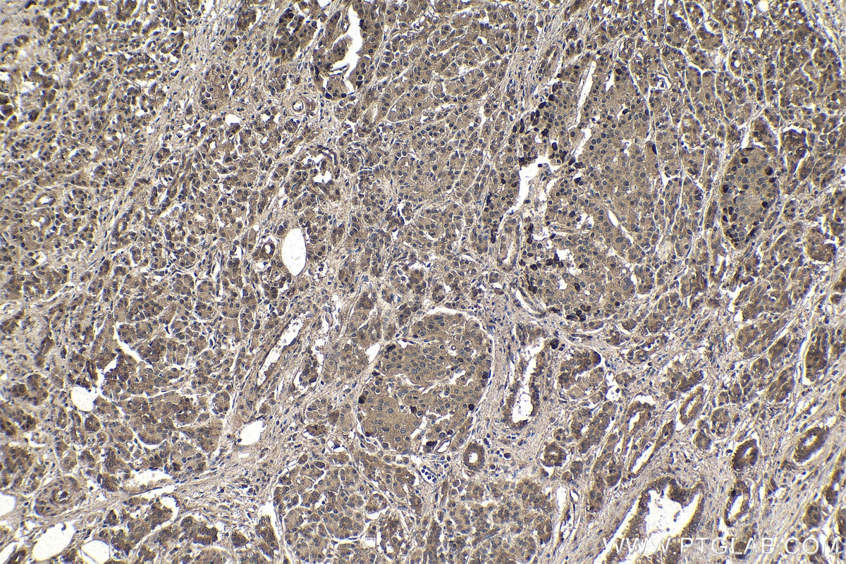 Immunohistochemistry (IHC) staining of human pancreas cancer tissue using MYSM1-Specific Polyclonal antibody (20078-1-AP)