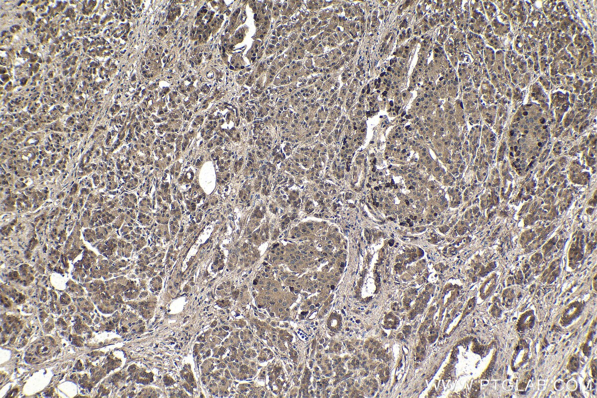 IHC staining of human pancreas cancer using 20078-1-AP