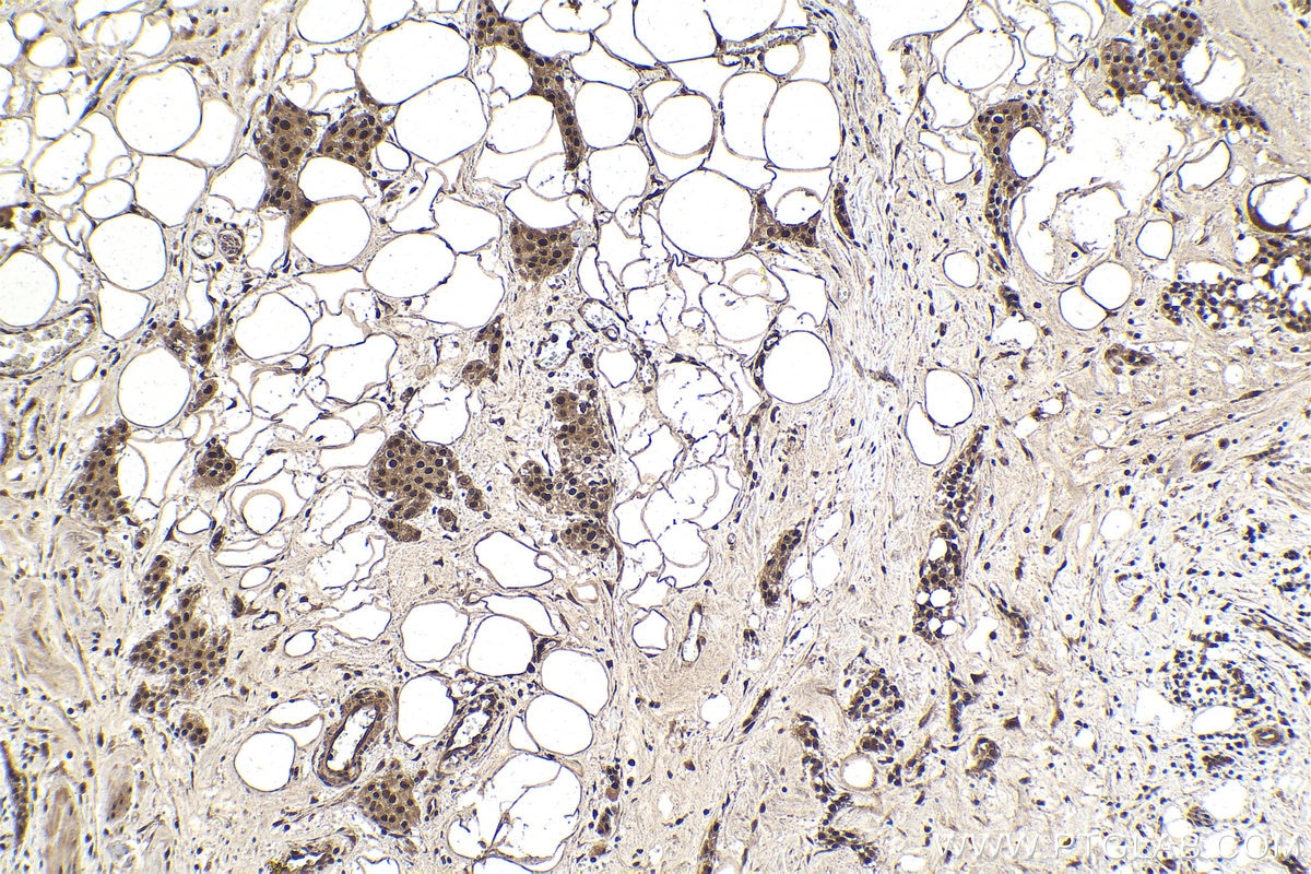 Immunohistochemistry (IHC) staining of human urothelial carcinoma tissue using MYSM1-Specific Polyclonal antibody (20078-1-AP)