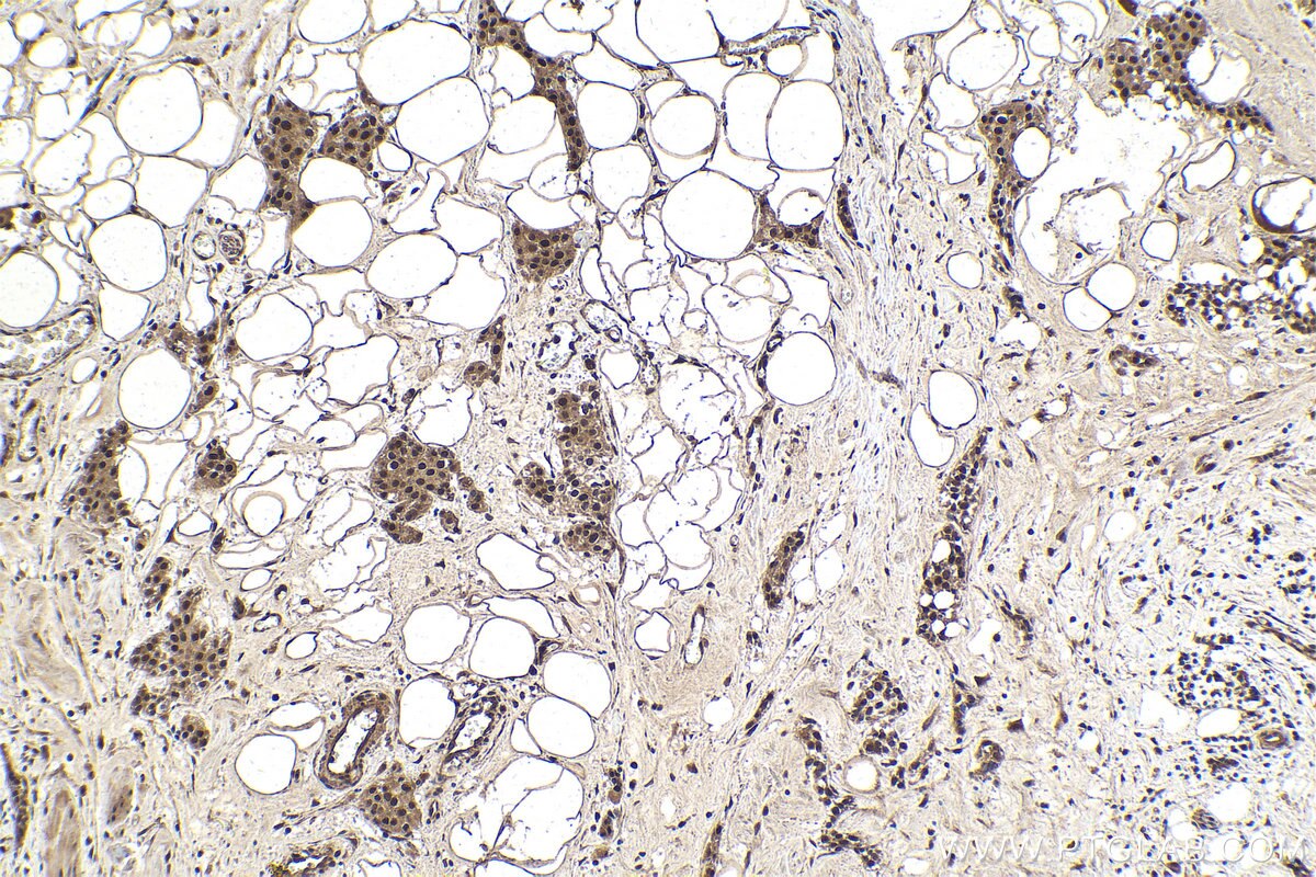 Immunohistochemistry (IHC) staining of human urothelial carcinoma tissue using MYSM1-Specific Polyclonal antibody (20078-1-AP)