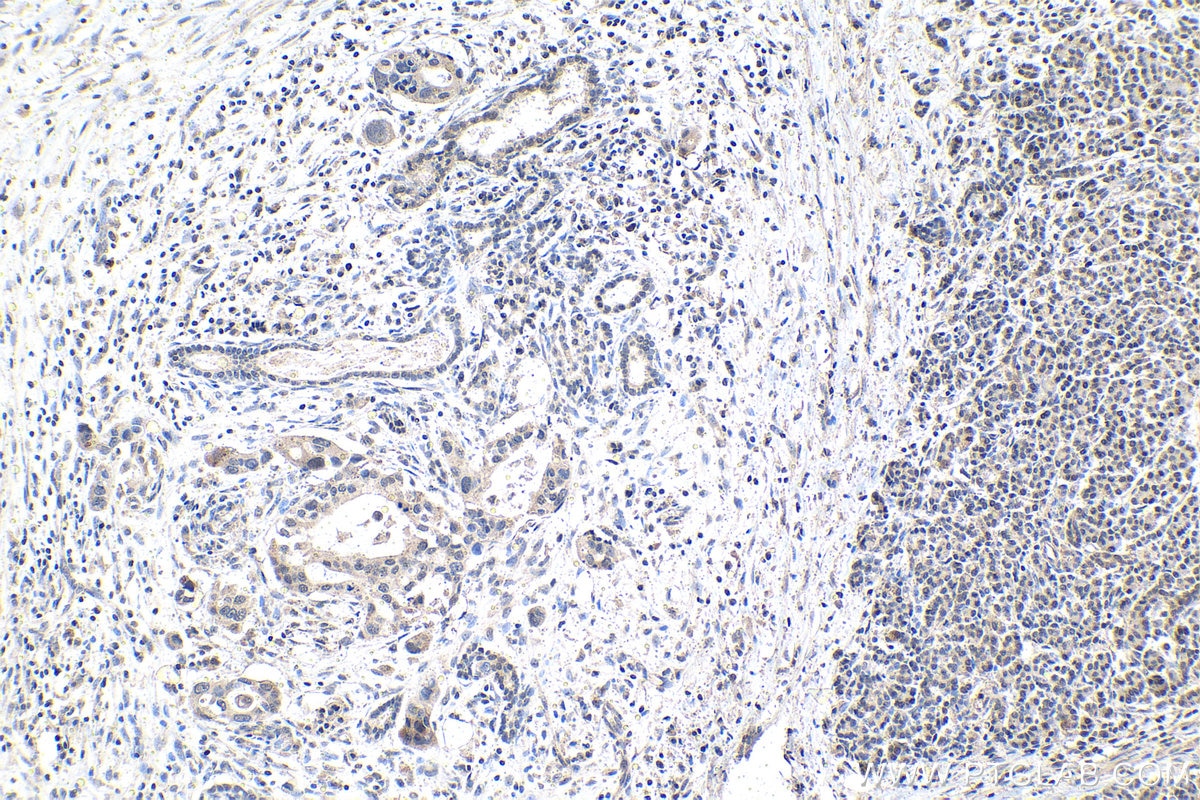 Immunohistochemistry (IHC) staining of human pancreas cancer tissue using MYST2 Polyclonal antibody (13751-1-AP)