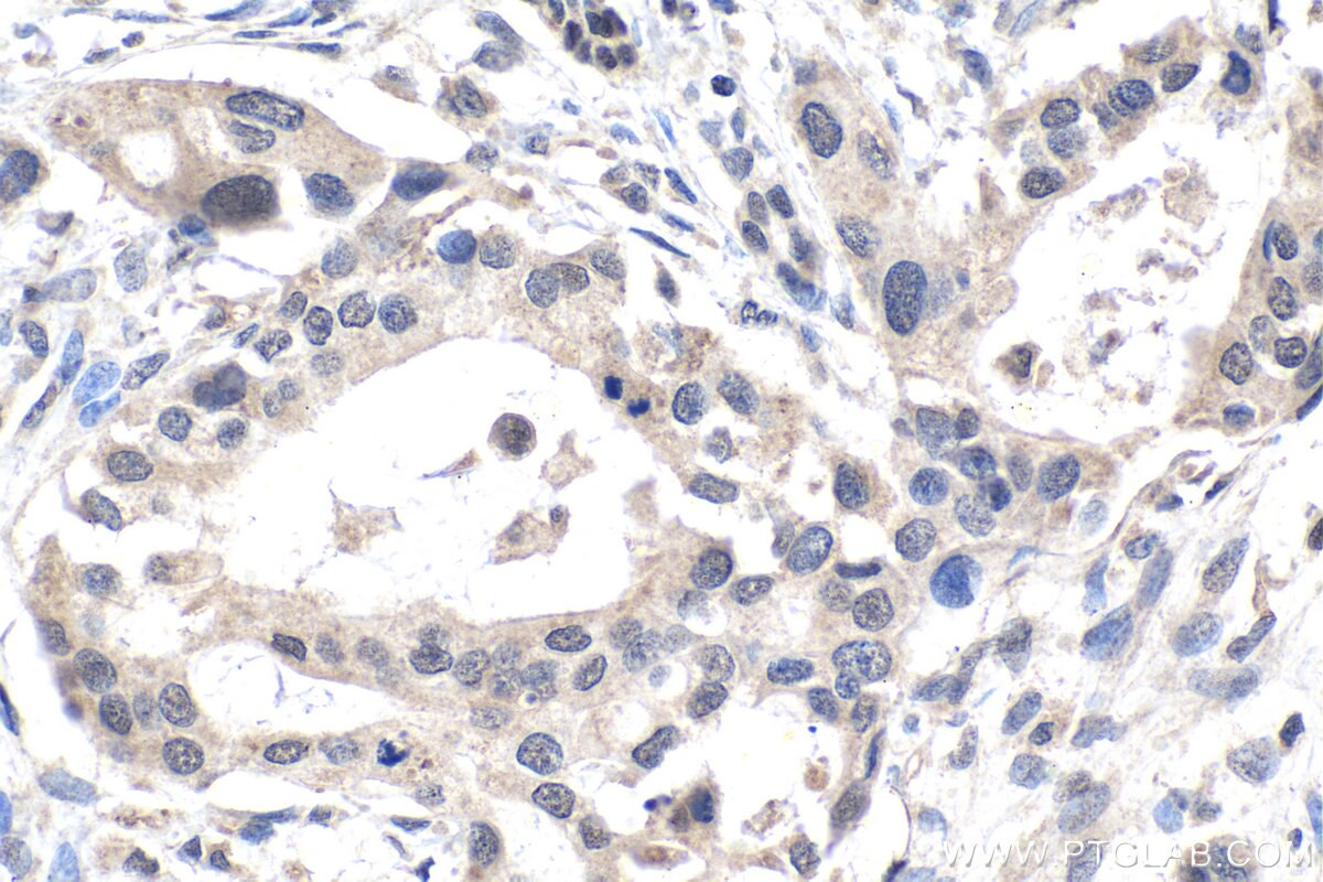 Immunohistochemistry (IHC) staining of human pancreas cancer tissue using MYST2 Polyclonal antibody (13751-1-AP)