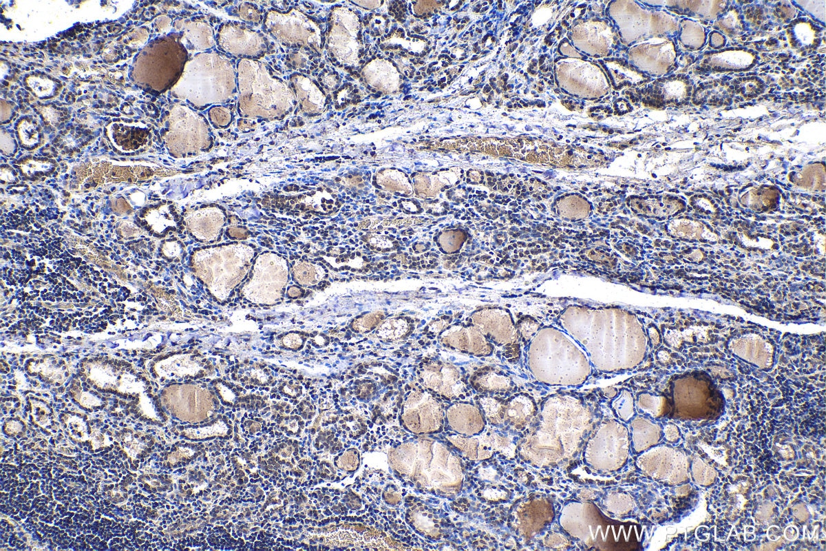 Immunohistochemistry (IHC) staining of human thyroid cancer tissue using MYST2 Polyclonal antibody (13751-1-AP)