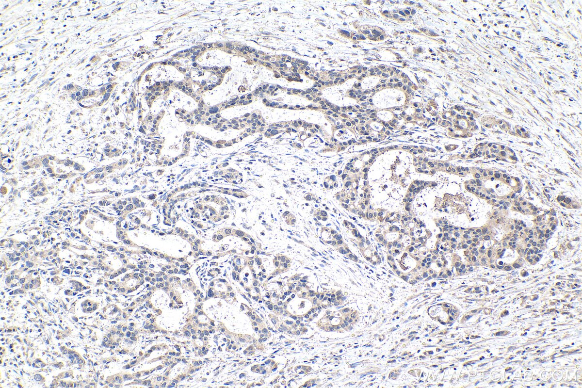 Immunohistochemistry (IHC) staining of human pancreas cancer tissue using MYST2 Polyclonal antibody (13751-1-AP)