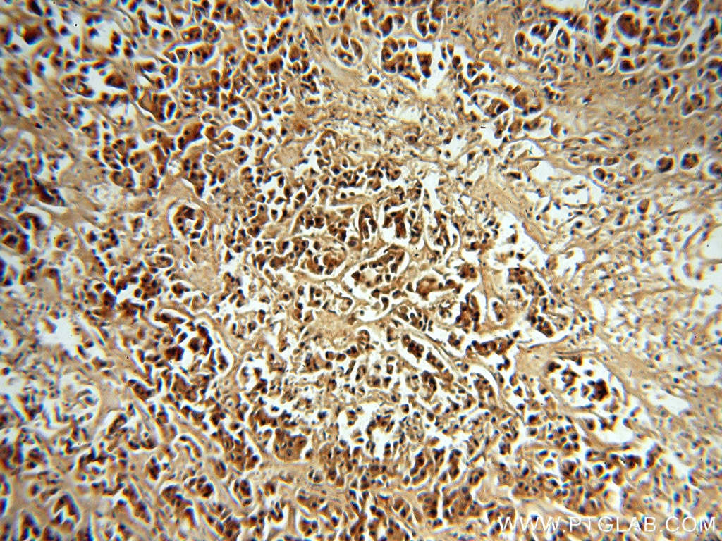 Immunohistochemistry (IHC) staining of human breast cancer tissue using MYST2 Polyclonal antibody (13751-1-AP)