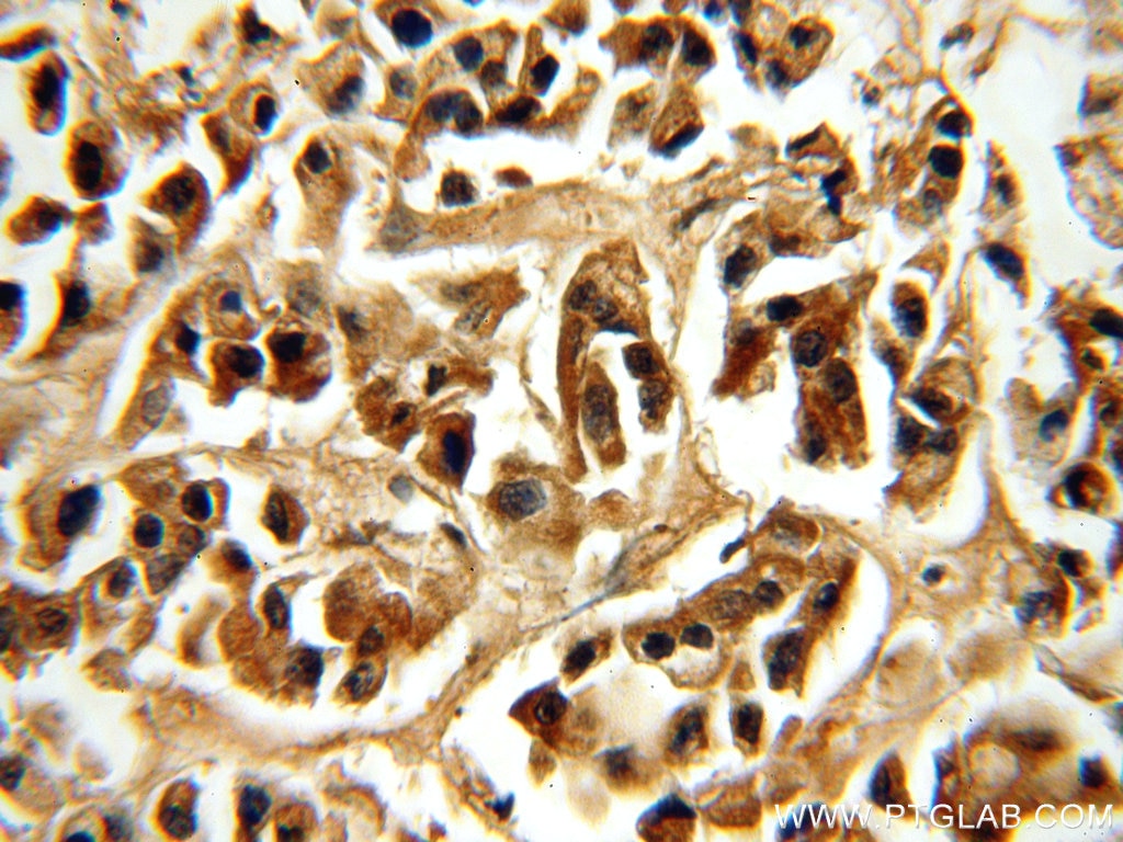 Immunohistochemistry (IHC) staining of human breast cancer tissue using MYST2 Polyclonal antibody (13751-1-AP)