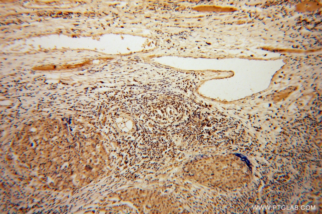 IHC staining of human ovary tumor using 13751-1-AP