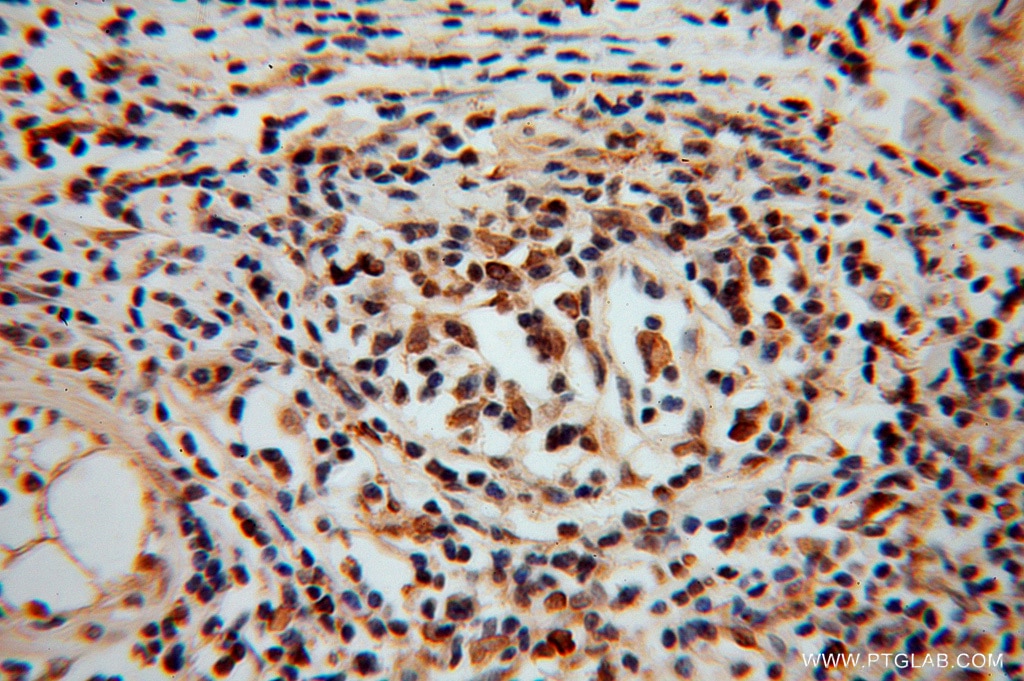 Immunohistochemistry (IHC) staining of human ovary tumor tissue using MYST2 Polyclonal antibody (13751-1-AP)
