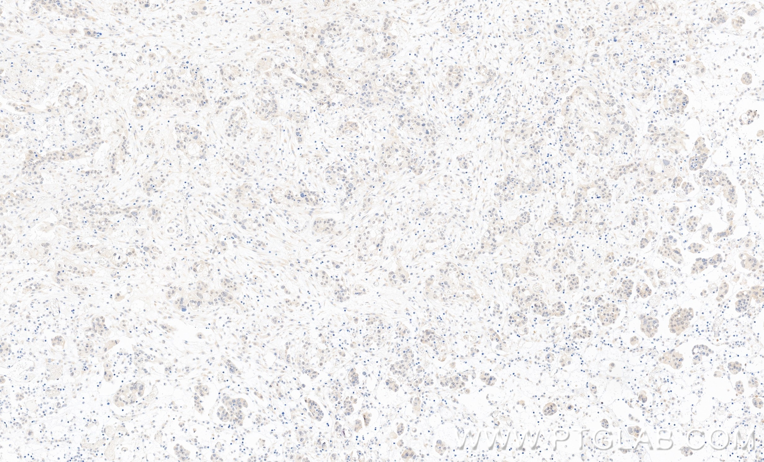 Immunohistochemistry (IHC) staining of human ovary cancer tissue using MYST2 Recombinant monoclonal antibody (86486-1-RR)