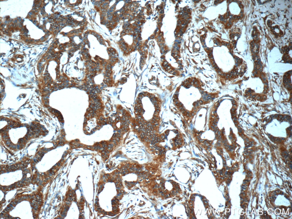 Immunohistochemistry (IHC) staining of human breast cancer tissue using Mammaglobin A Polyclonal antibody (25645-1-AP)