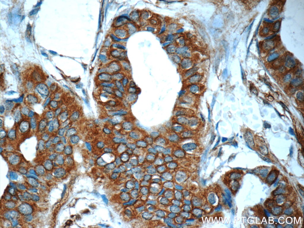 Immunohistochemistry (IHC) staining of human breast cancer tissue using Mammaglobin A Polyclonal antibody (25645-1-AP)