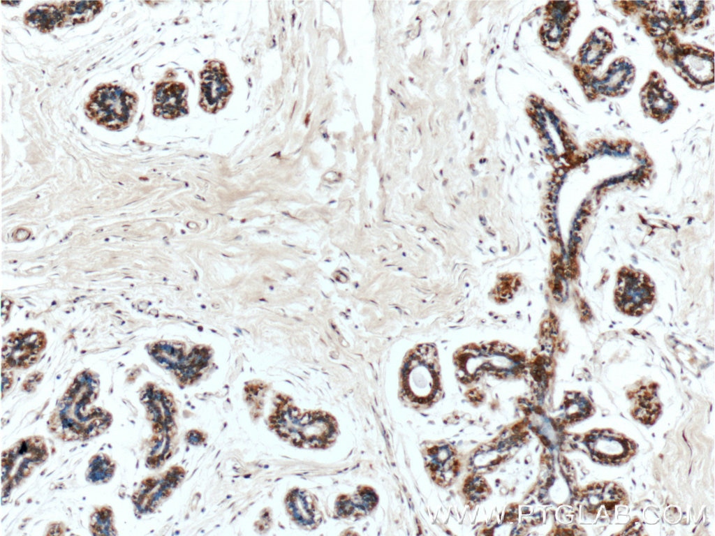 Immunohistochemistry (IHC) staining of human breast tissue using Mammaglobin A Polyclonal antibody (25645-1-AP)