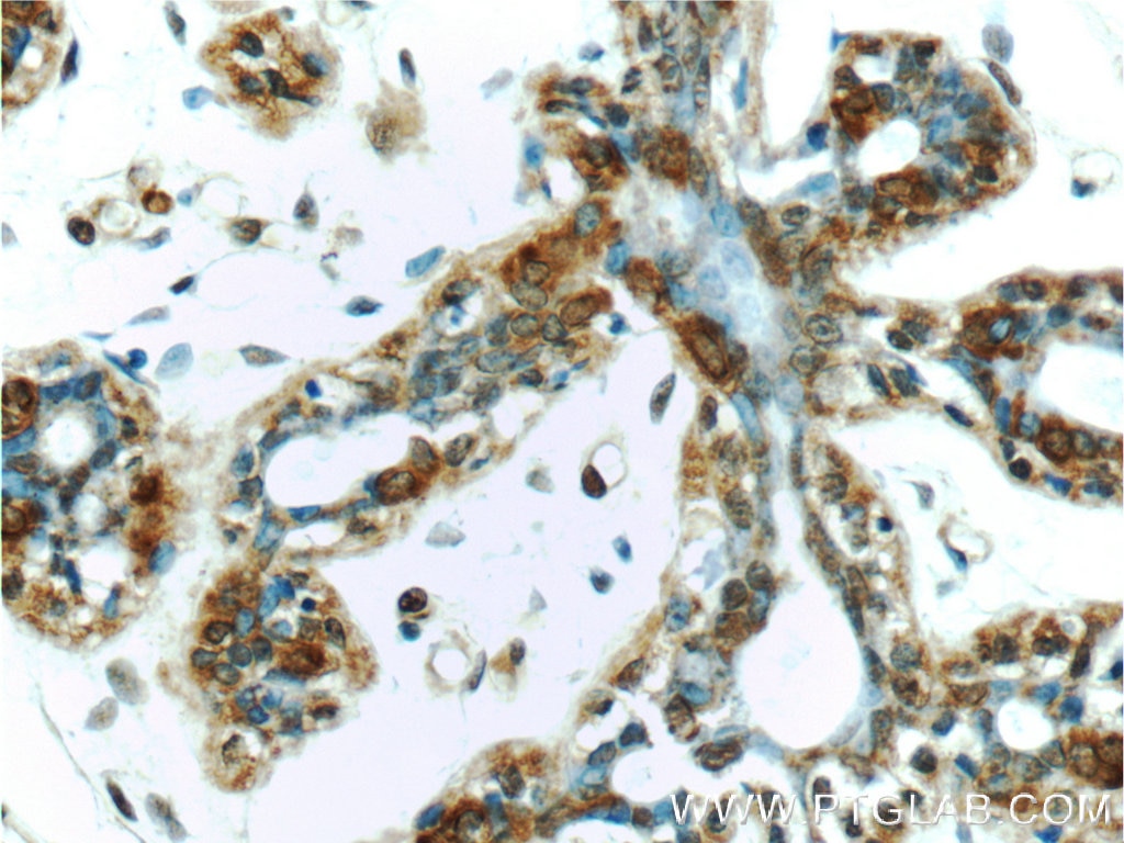 Immunohistochemistry (IHC) staining of human breast tissue using Mammaglobin A Polyclonal antibody (25645-1-AP)