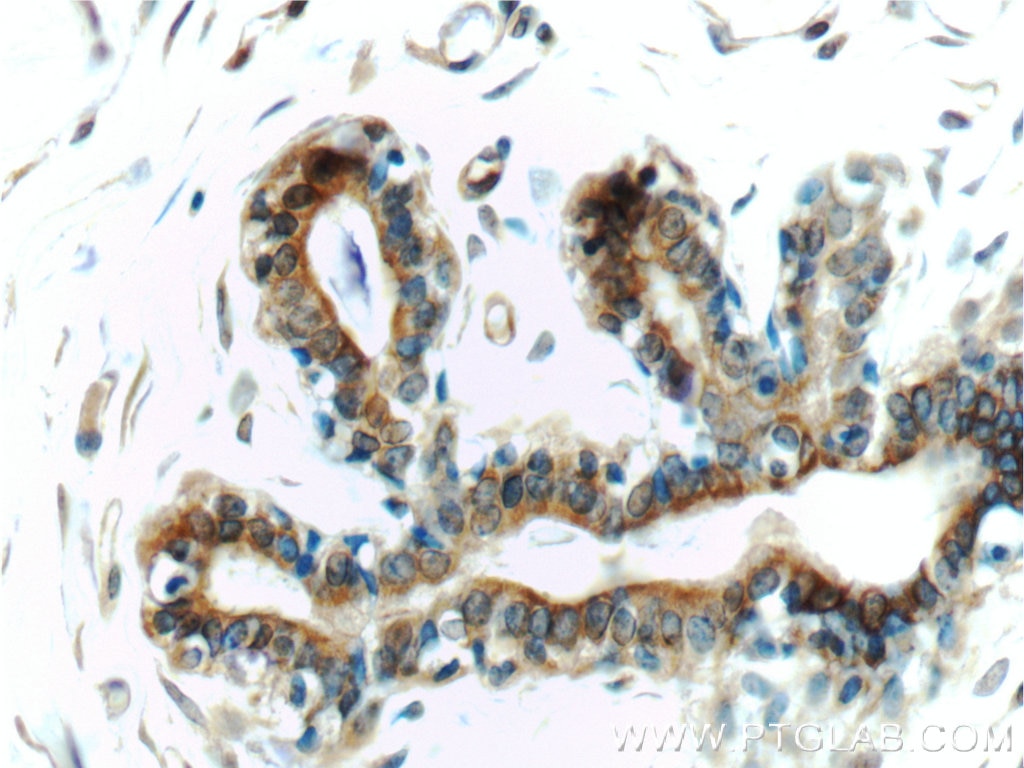 Immunohistochemistry (IHC) staining of human breast tissue using Mammaglobin A Polyclonal antibody (25645-1-AP)