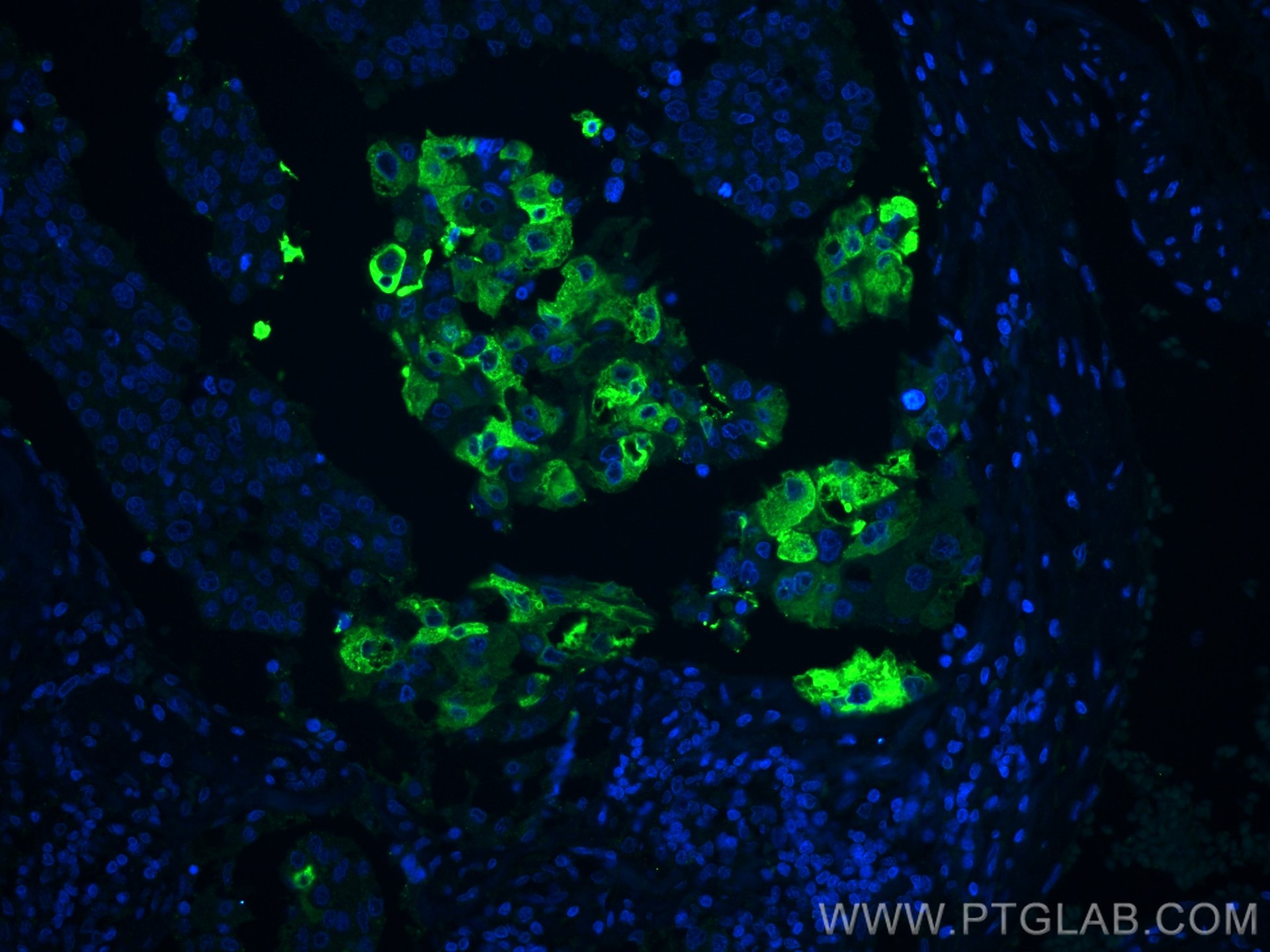 Immunofluorescence (IF) / fluorescent staining of human breast cancer tissue using Mammaglobin A Monoclonal antibody (66237-1-Ig)