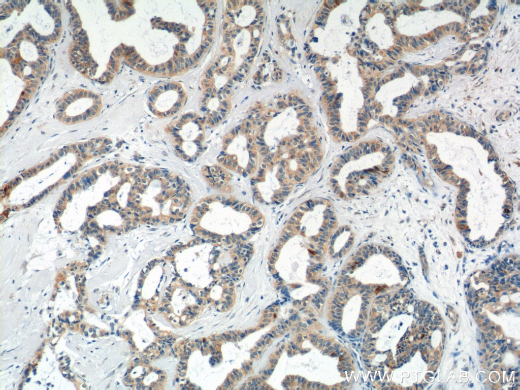 Immunohistochemistry (IHC) staining of human breast cancer tissue using Mammaglobin A Monoclonal antibody (66237-1-Ig)