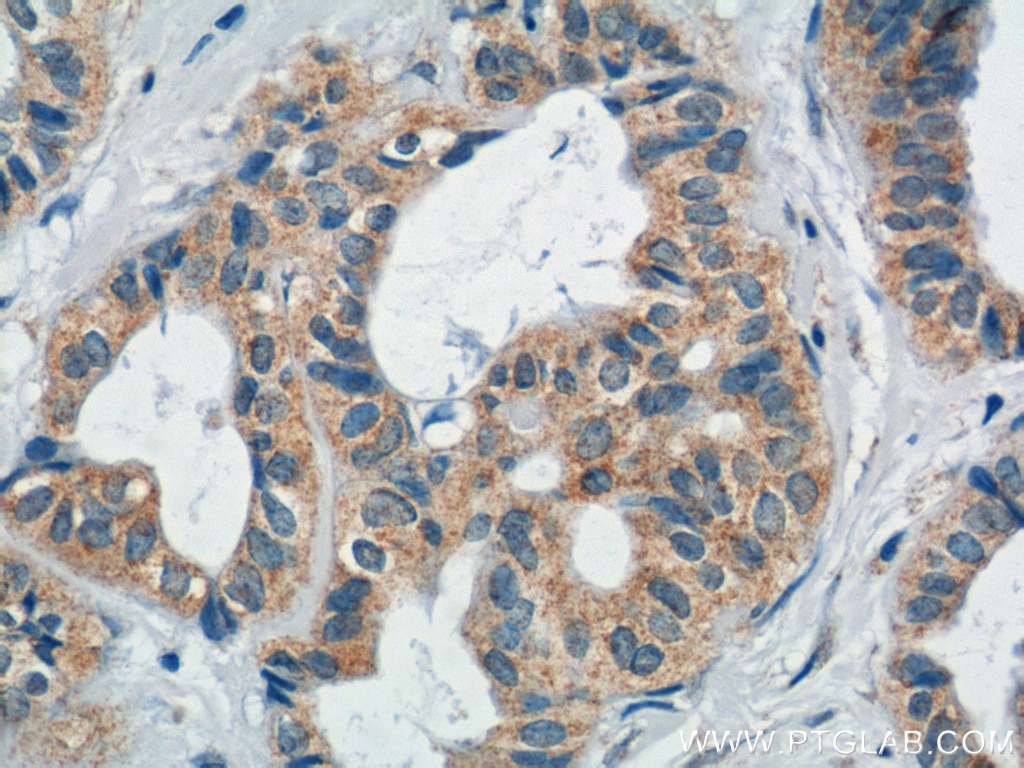 Immunohistochemistry (IHC) staining of human breast cancer tissue using Mammaglobin A Monoclonal antibody (66237-1-Ig)