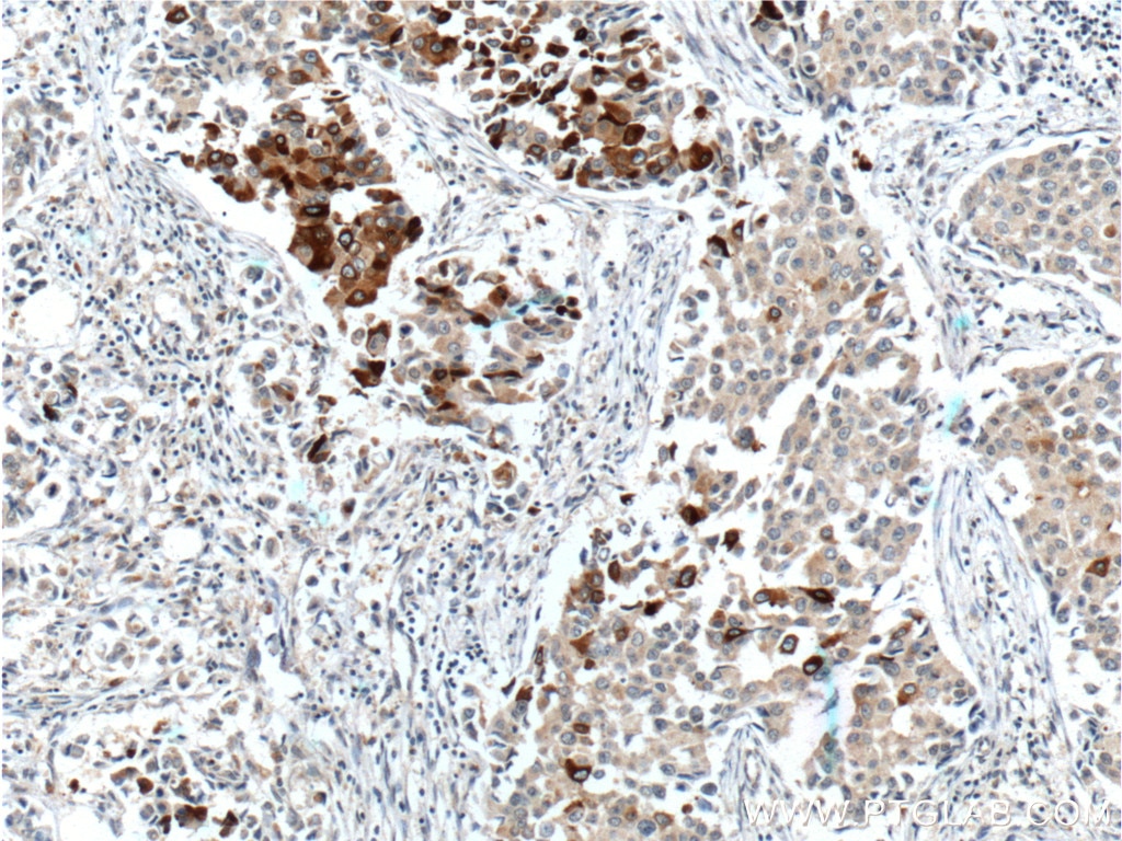 Immunohistochemistry (IHC) staining of human breast cancer tissue using Mammaglobin A Monoclonal antibody (66237-1-Ig)