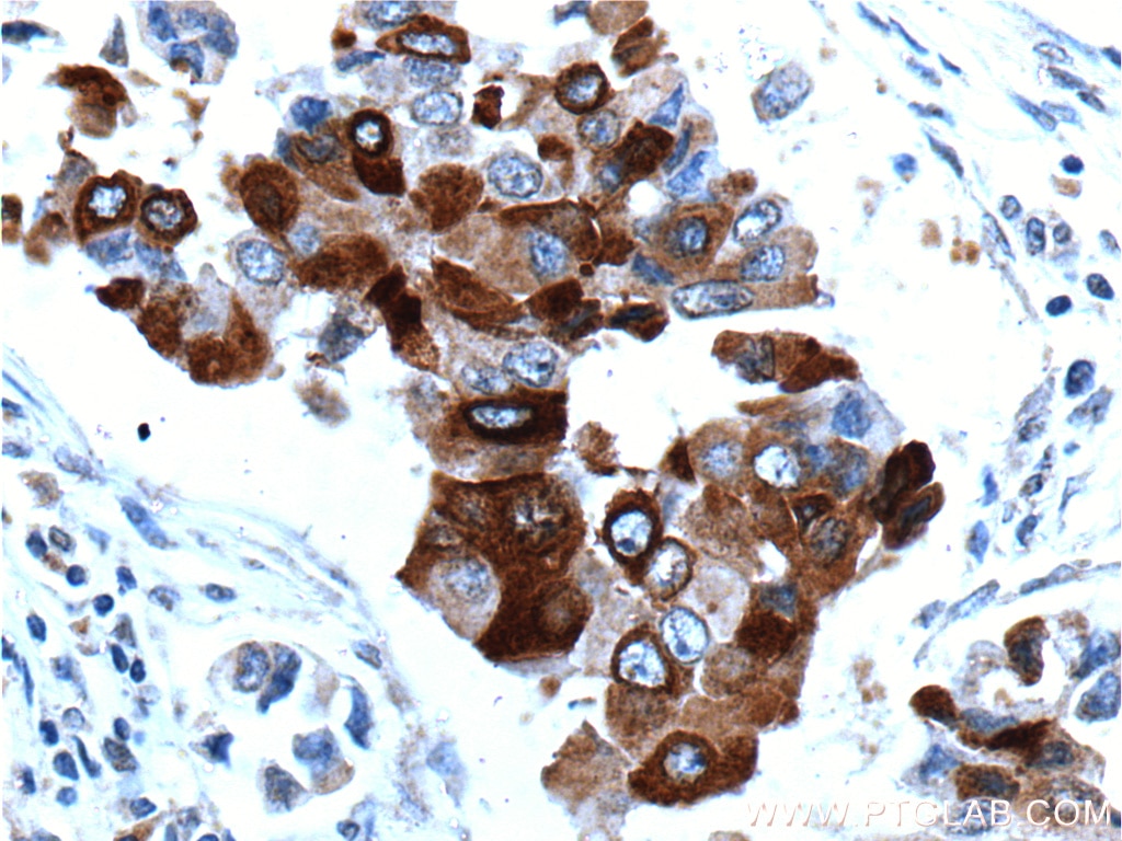 Immunohistochemistry (IHC) staining of human breast cancer tissue using Mammaglobin A Monoclonal antibody (66237-1-Ig)