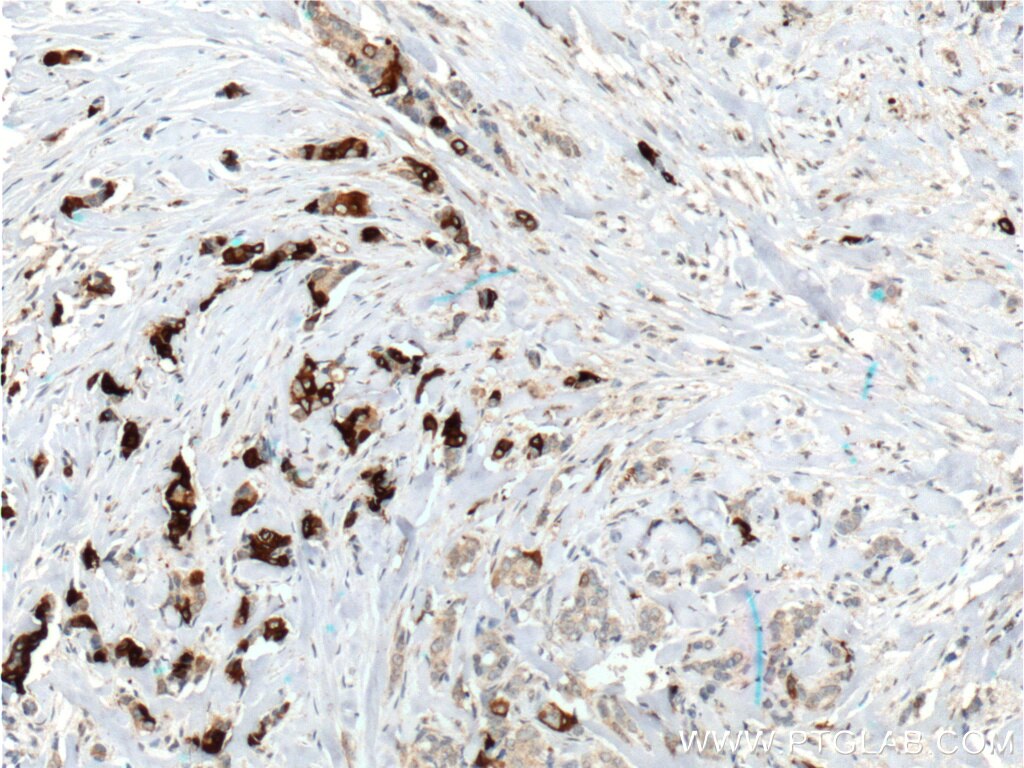 Immunohistochemistry (IHC) staining of human breast cancer tissue using Mammaglobin A Monoclonal antibody (66237-1-Ig)