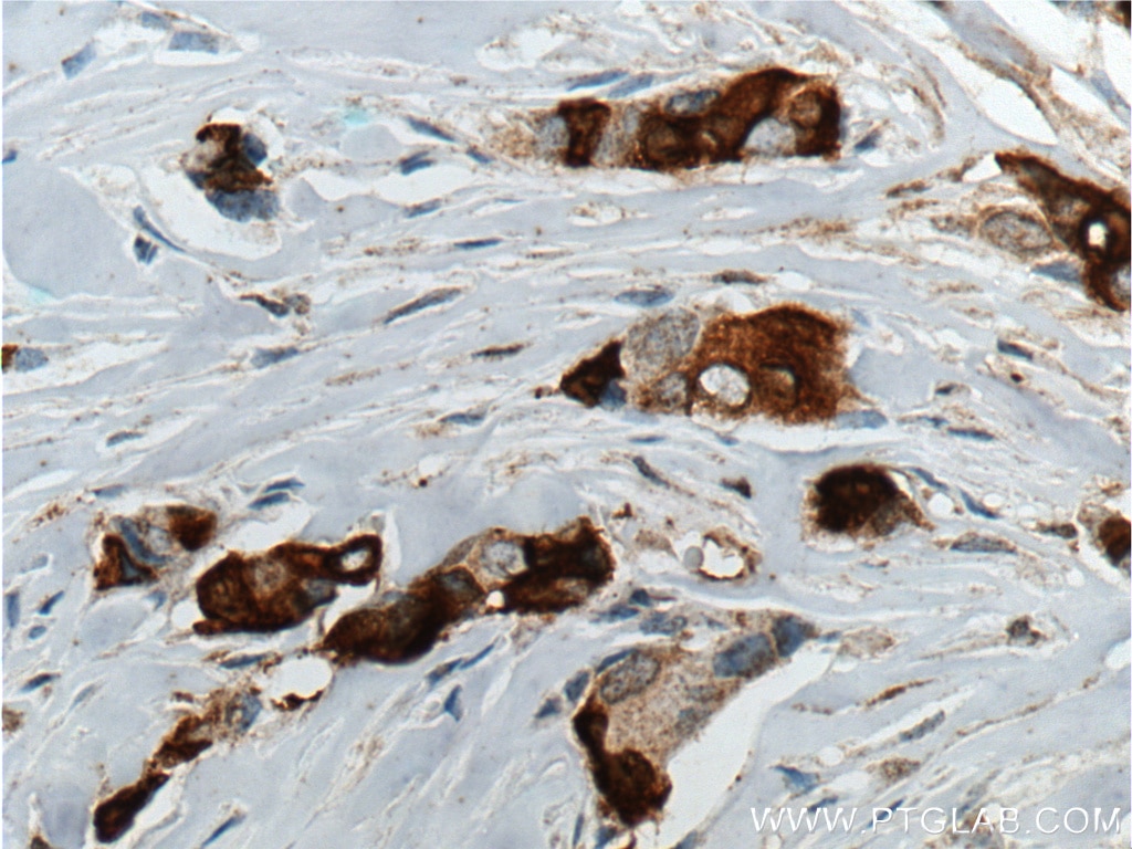 Immunohistochemistry (IHC) staining of human breast cancer tissue using Mammaglobin A Monoclonal antibody (66237-1-Ig)