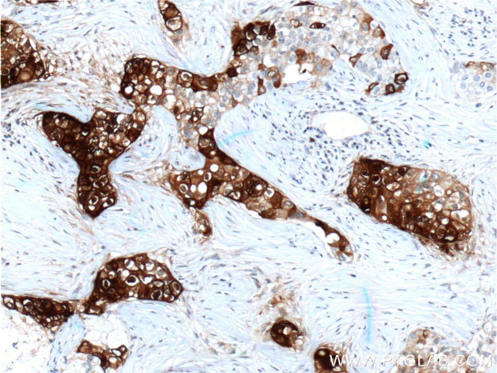 Immunohistochemistry (IHC) staining of human breast cancer tissue using Mammaglobin A Monoclonal antibody (66237-1-Ig)