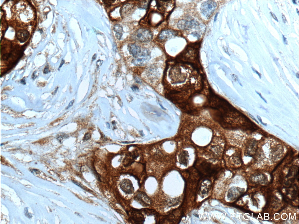 IHC staining of human breast cancer using 66237-1-Ig