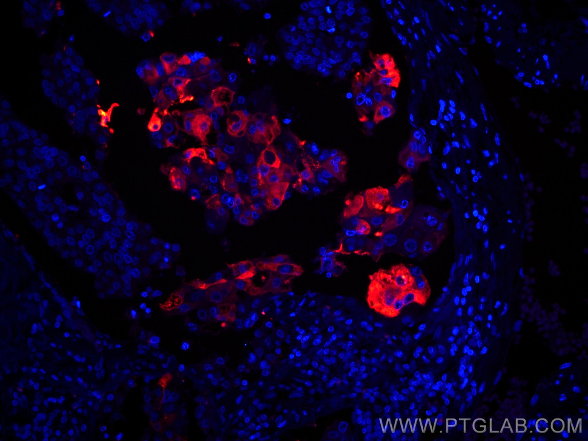 Immunofluorescence (IF) / fluorescent staining of human breast cancer tissue using CoraLite®594-conjugated Mammaglobin A Monoclonal a (CL594-66237)