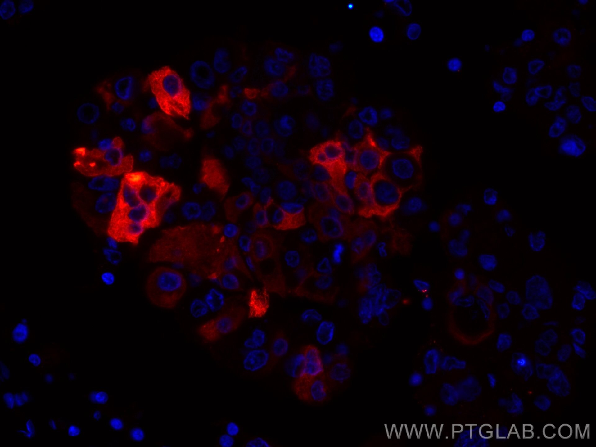 Immunofluorescence (IF) / fluorescent staining of human breast cancer tissue using CoraLite®594-conjugated Mammaglobin A Monoclonal a (CL594-66237)