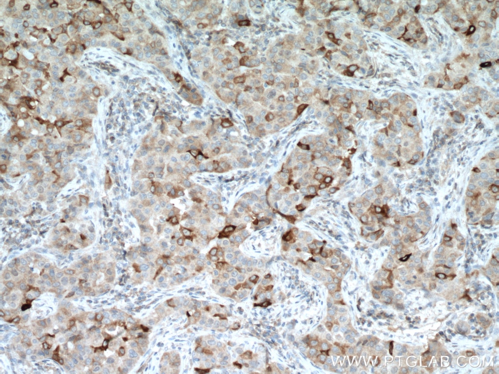 Immunohistochemistry (IHC) staining of human breast cancer tissue using Mammaglobin B Polyclonal antibody (21211-1-AP)