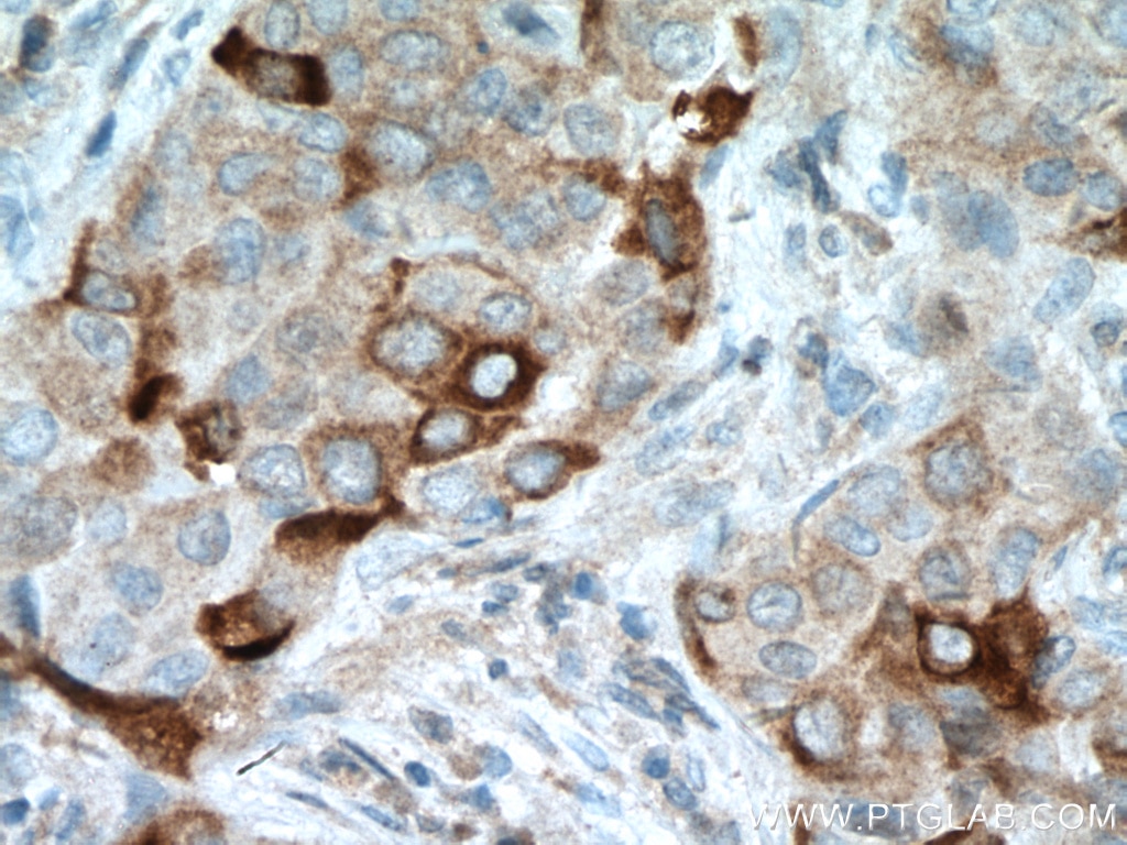 Immunohistochemistry (IHC) staining of human breast cancer tissue using Mammaglobin B Polyclonal antibody (21211-1-AP)