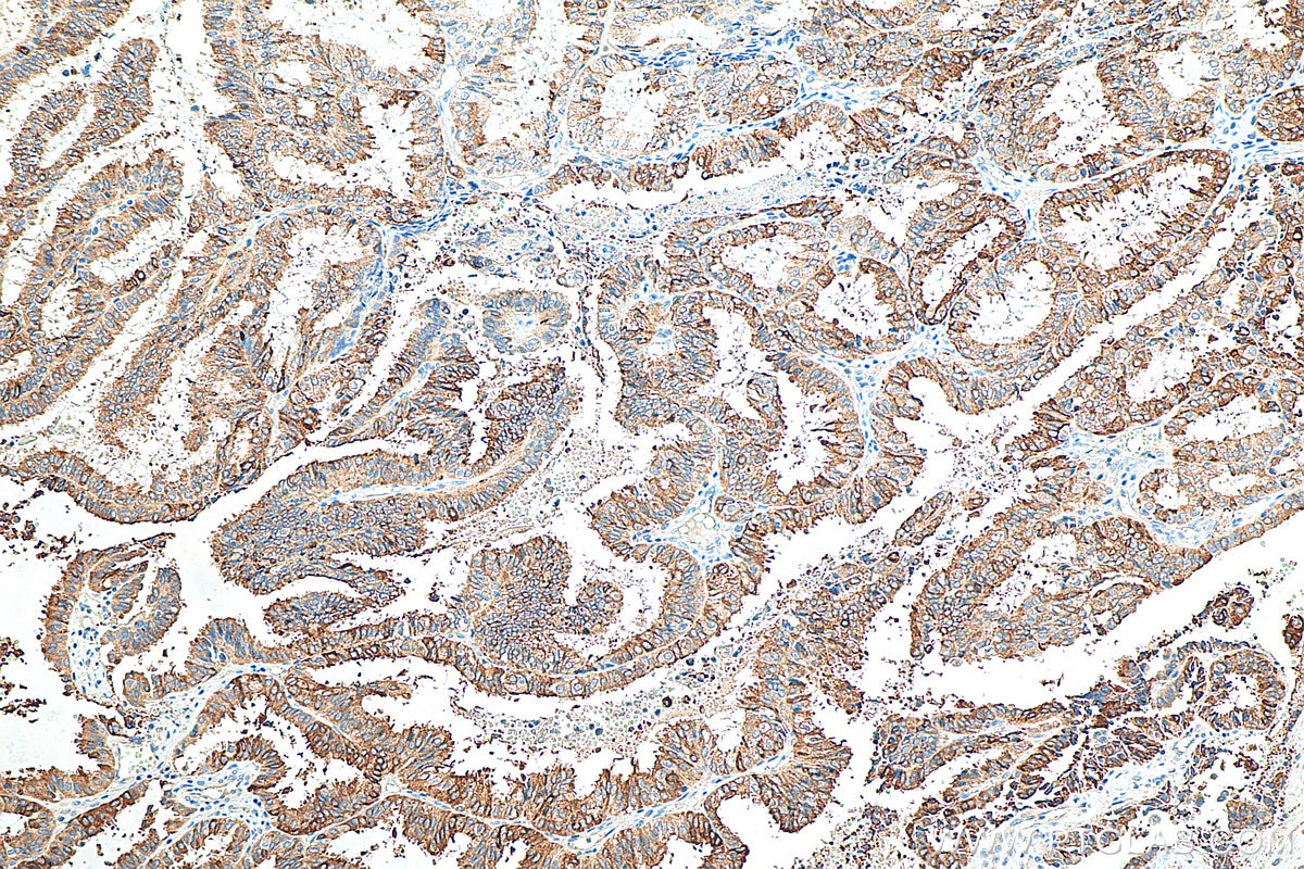 Immunohistochemistry (IHC) staining of human ovary tumor tissue using Mammaglobin B Polyclonal antibody (21211-1-AP)