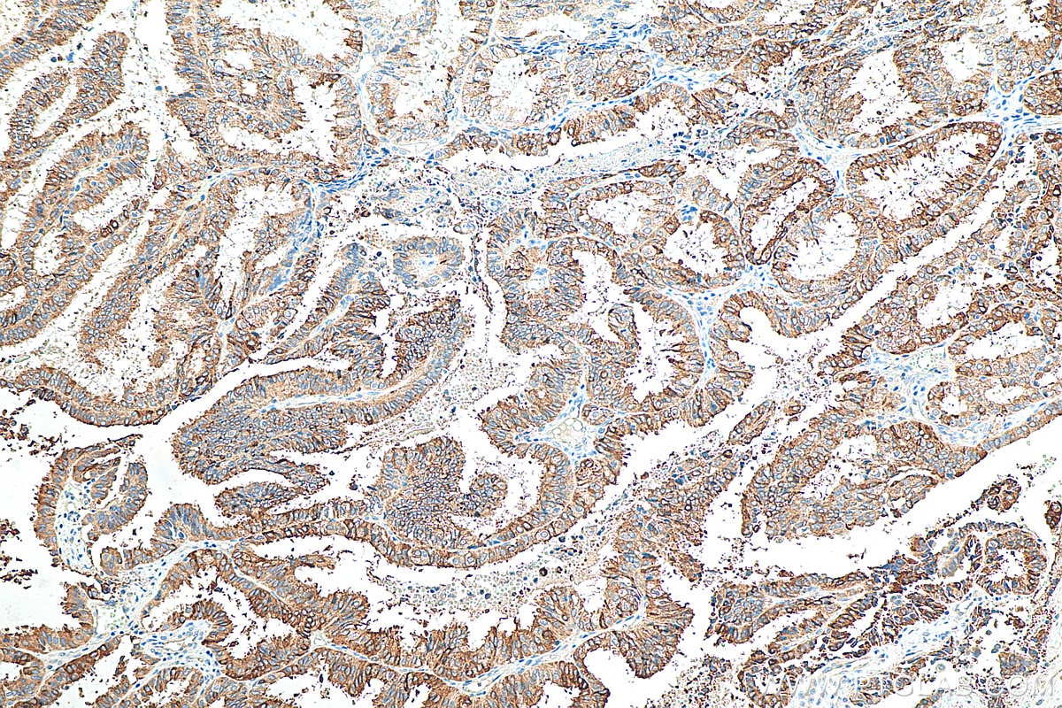 IHC staining of human ovary tumor using 21211-1-AP